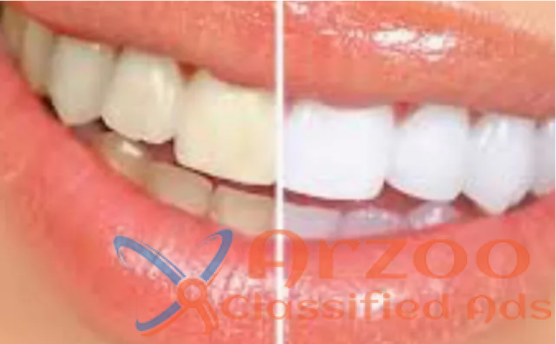 Tooth Whitening Training