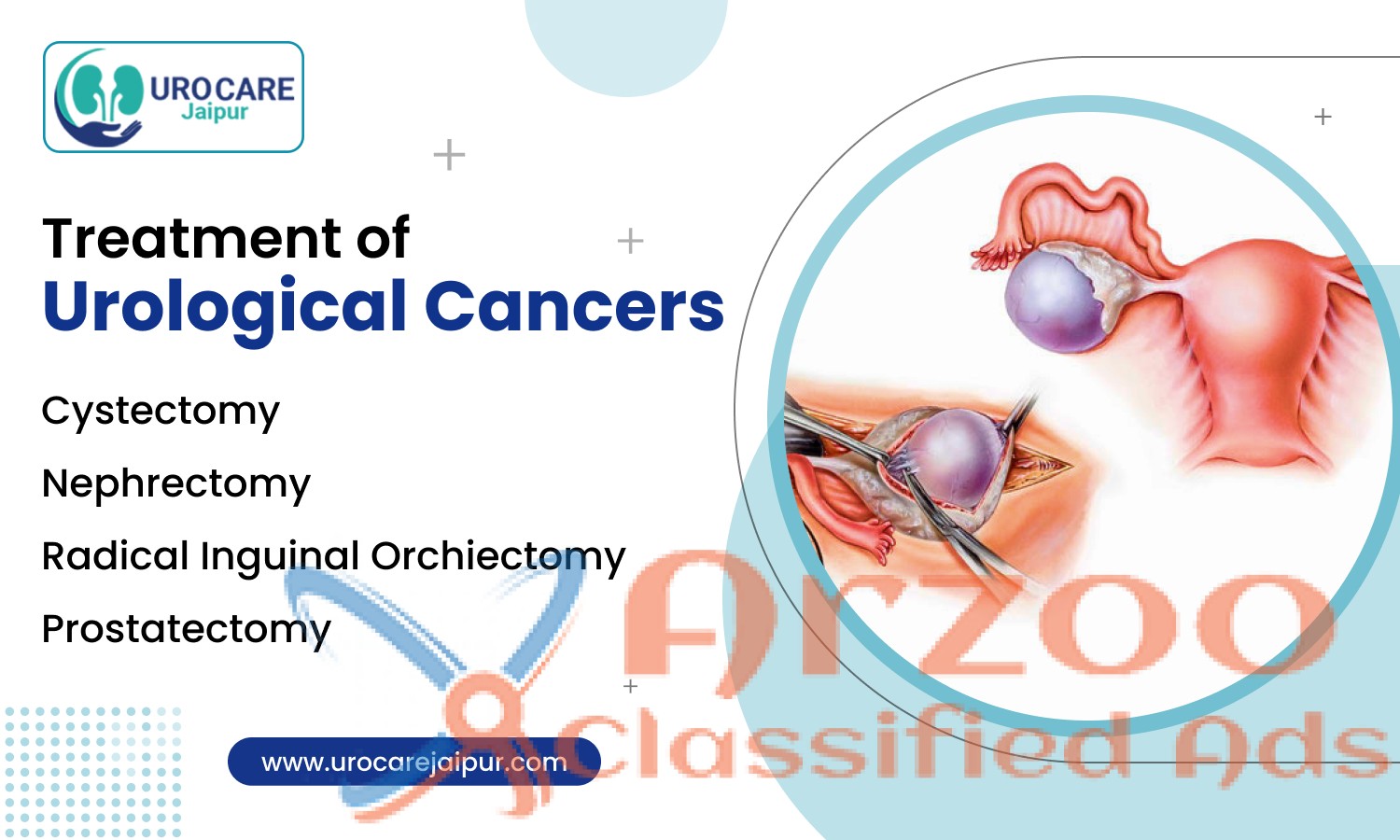 Find the best urologist near me for Prostate cance